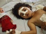 แพทย์ไร้พรมแดน ชี้ ผู้ได้รับบาดเจ็บในการโจมตีกาซ่า 51 วัน ส่วนใหญ่เป็นเด็ก